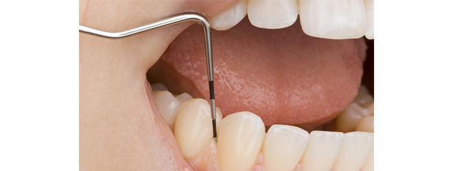 歯周病検査と治療