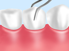歯の揺れ具合の検査