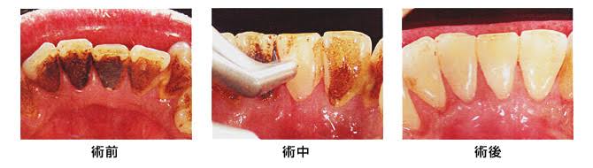 着色が気になる方 エアフロー