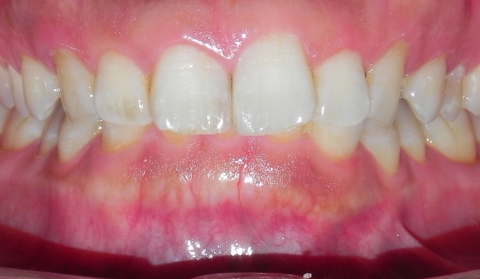 歯茎のホワイトニング