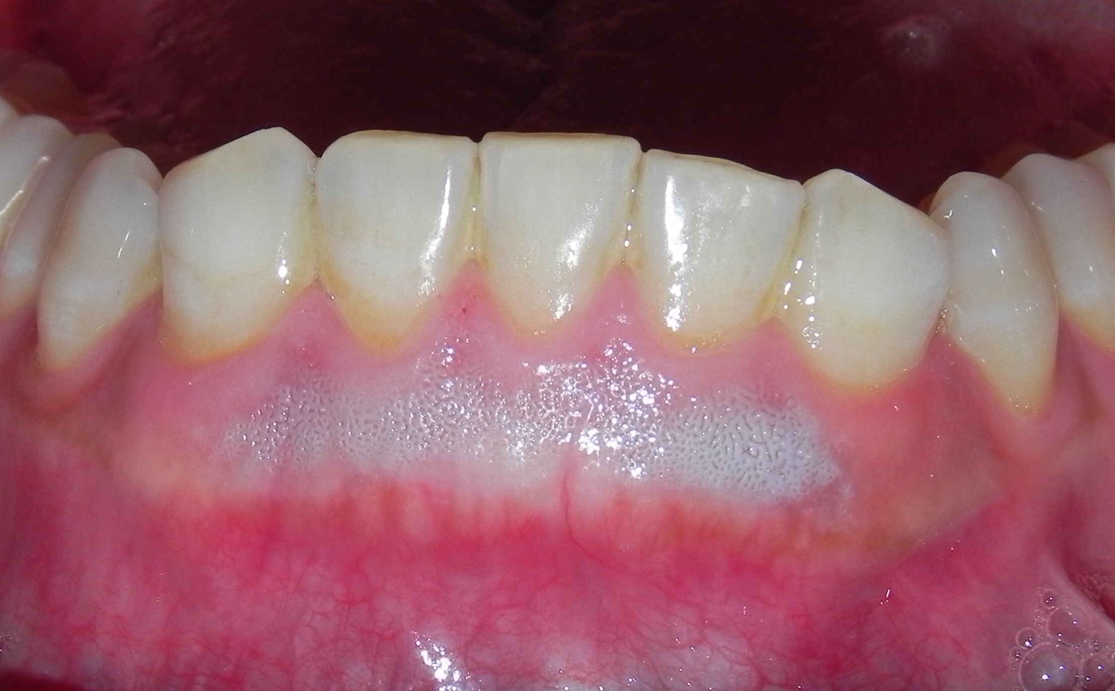 歯茎のホワイトニング
