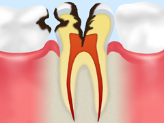 C3：神経まで達した虫歯