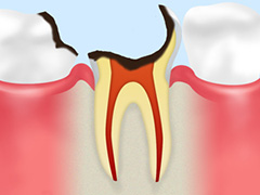 C4：歯根まで達した虫歯