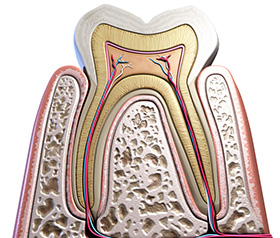 重度の虫歯の治療「根管治療」とは？