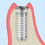 STEP4： インプラント埋入手術