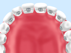 リンガルブラケット矯正法（舌側矯正）