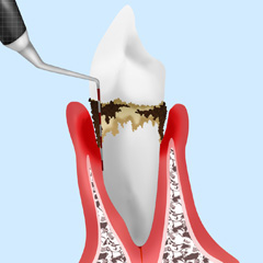 歯周ポケットの検査