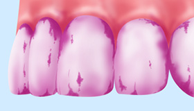 歯垢（プラーク）の染め出し