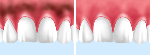 歯ぐきの黒ずみもきれいに～ガムブリーチ～